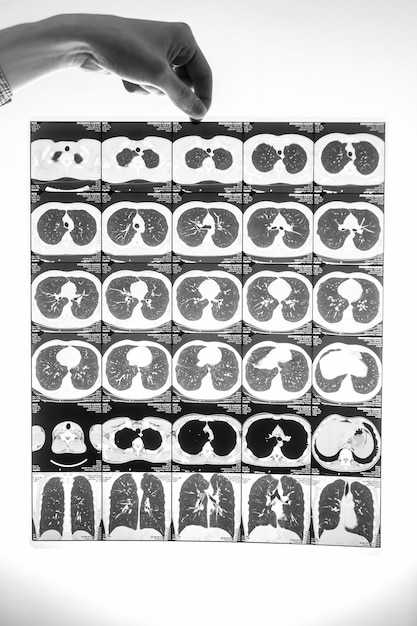 A side by side comparison image showing an original CT scan of a lung next to a processed image from machine learning software highlighting suspicious nodules, enhancing their visibility. The image conveys the improvement in disease detection through AI assistance.